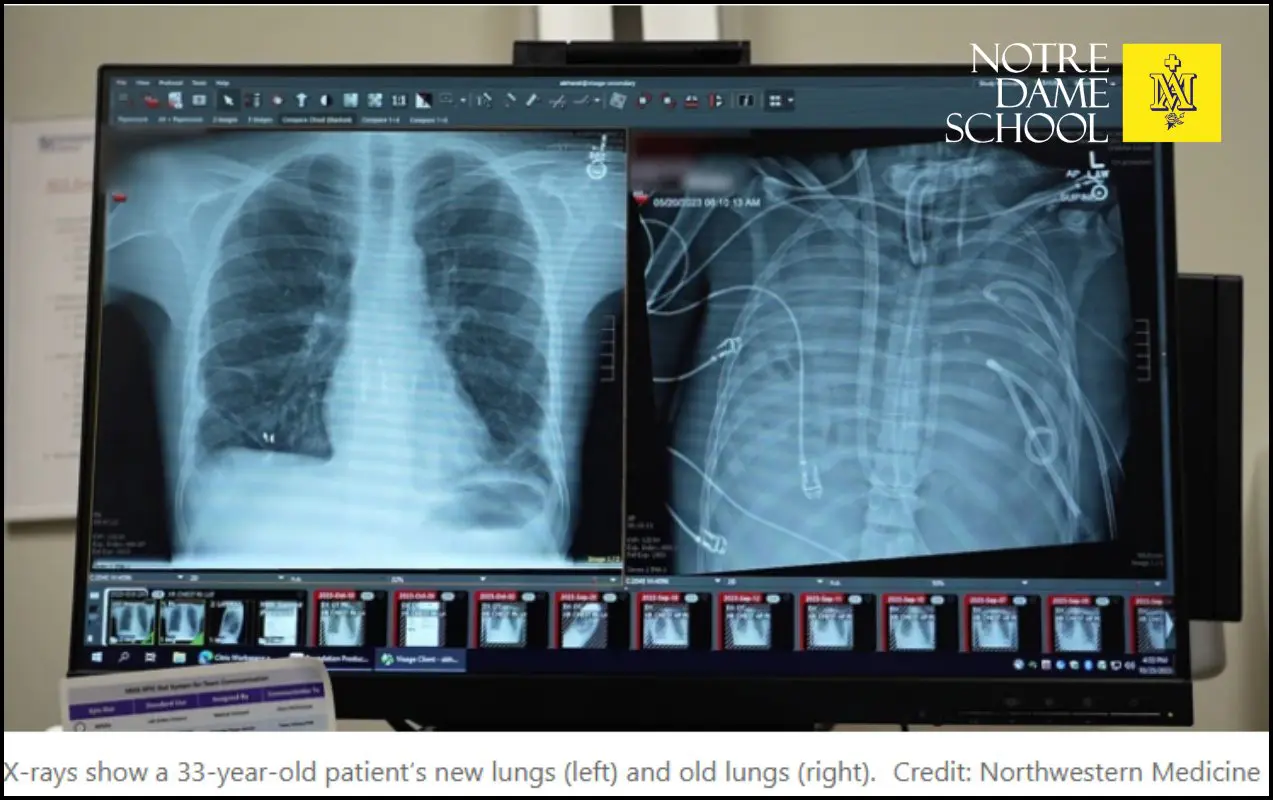 Senior Science Corner - XRays of Lungs
